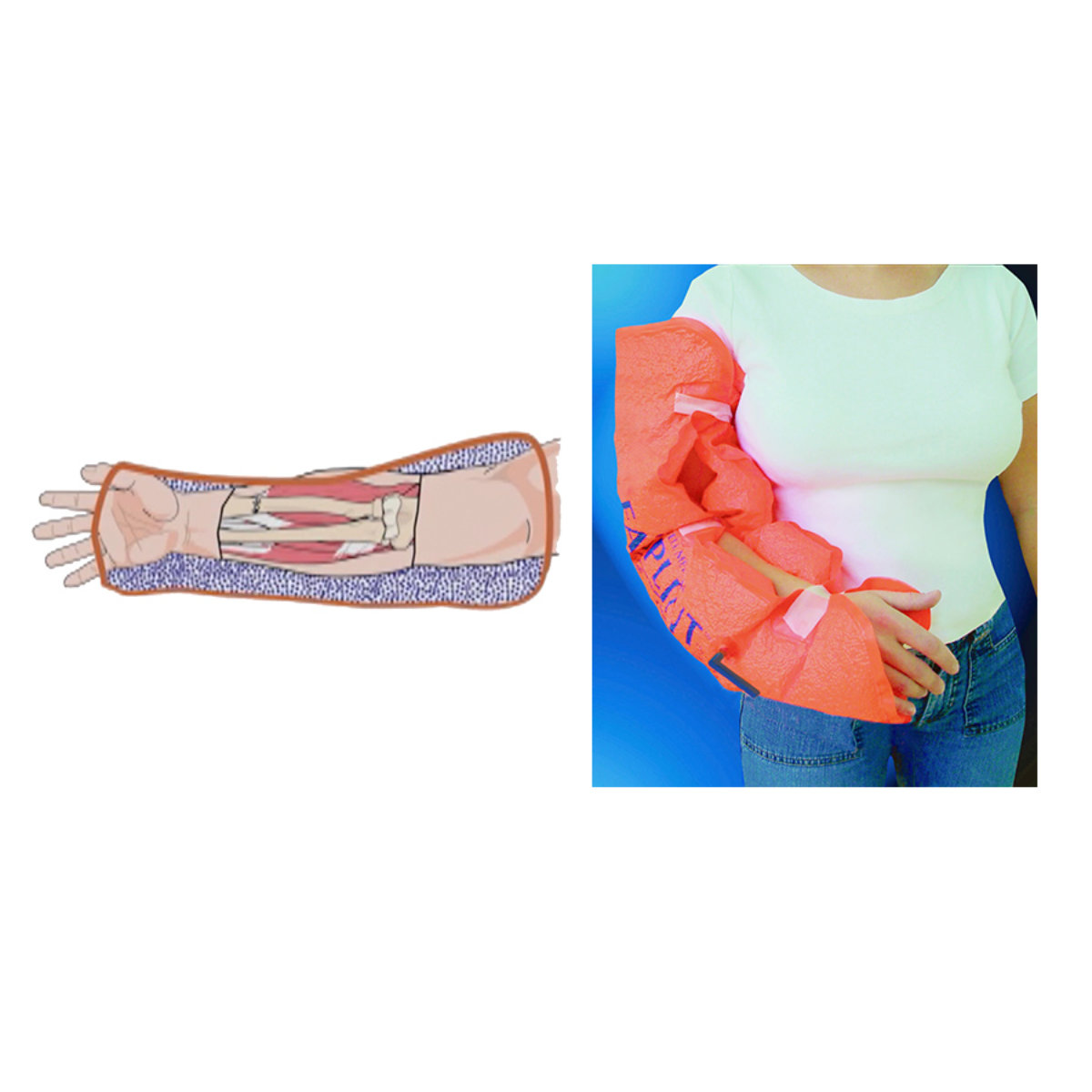 Hartwell Evac-U-Splint Mattress